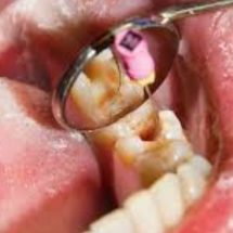 Could a Root Canal Be the Cause of Your Chronic Health Problem?