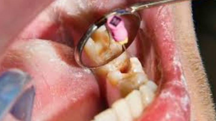 Could-a-Root-Canal-Be-the-Cause-of-Your-Chronic-Health-Problem