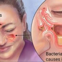 How To Kill Sinus Infections In Just 2 Minutes With Hydrogen Peroxide And Sea Salt