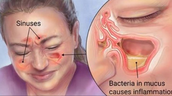 How-To-Kill-Sinus-Infections-In-Just-2-Minutes-With-Hydrogen-Peroxide-And-Sea-Salt