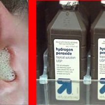 Hydrogen Peroxide Can Clear Ear Infections and Remove Ear Wax – Here’s How to Use it