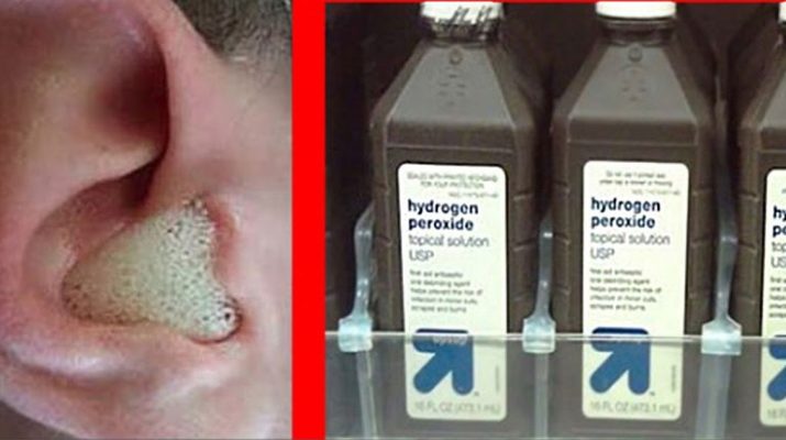 Hydrogen-Peroxide-Can-Clear-Ear-Infections-and-Remove-Ear-Wax