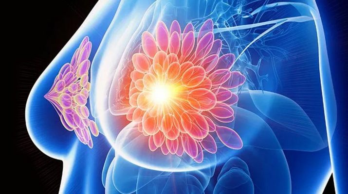 Researchers-Treat-HER2-Positive-Breast-Cancer-Without-Chemo