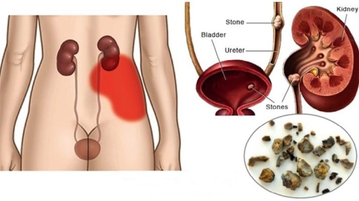 You-Need-A-Kidney-Cleanse.-Here’s-How-To-Flush-Out-Toxins-From-Your-Kidneys