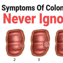 6 Silent Symptoms Of Colon Cancer to Never Ignore