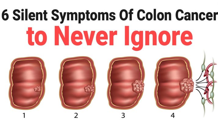 6-Silent-Symptoms-Of-Colon-Cancer-to-Never-Ignore