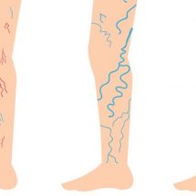 Incredibly Simple Ways to Fight Varicose and Spider Veins