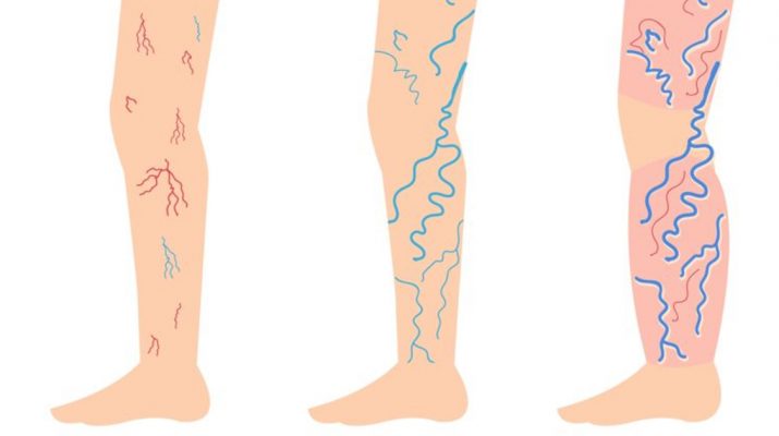 Incredibly-Simple-Ways-to-Fight-Varicose-and-Spider-Veins