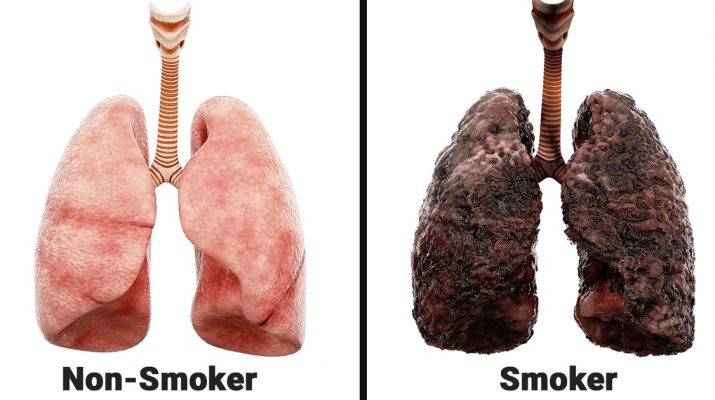 Nurse-Explains-What-Smoking-Every-Day-Does-To-Your-Lungs