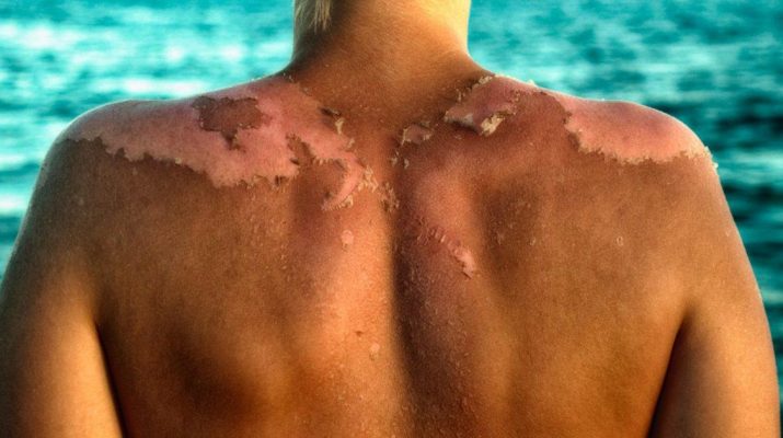 This-Is-How-Sunscreen-Could-Be-Causing-Skin-Cancer,-Not-the-Sun