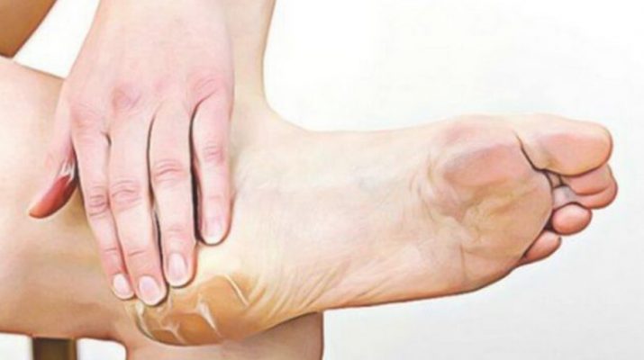 White-Vinegar-and-Onion-The-Most-Effective-Remedy-for-Feet-Calluses