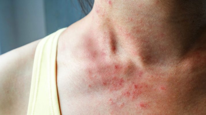 10-Things-Itchy-Skin-Says-About-Your-Health