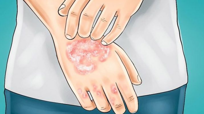 12-Foods-That-Make-Eczema-Worse