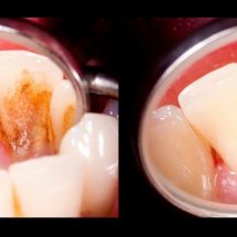 4 Mixtures That Completely Remove Plaque From Your Teeth