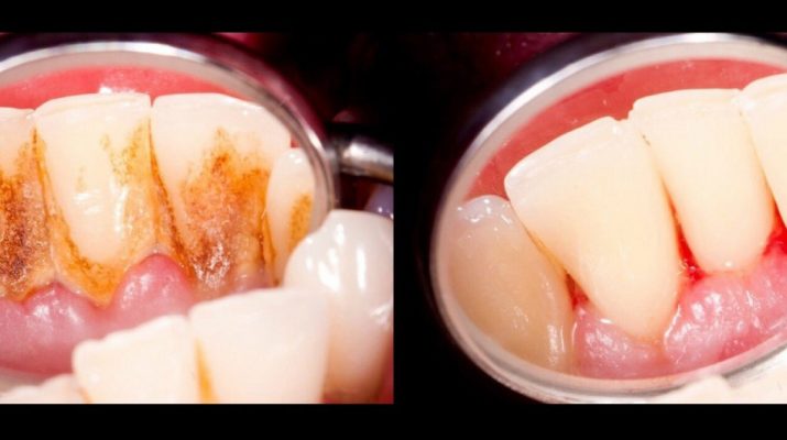 4-Mixtures-That-Completely-Remove-Plaque-From-Your-Teeth