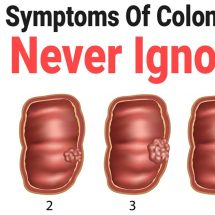 6 Silent Symptoms Of Colon Cancer to Never Ignore