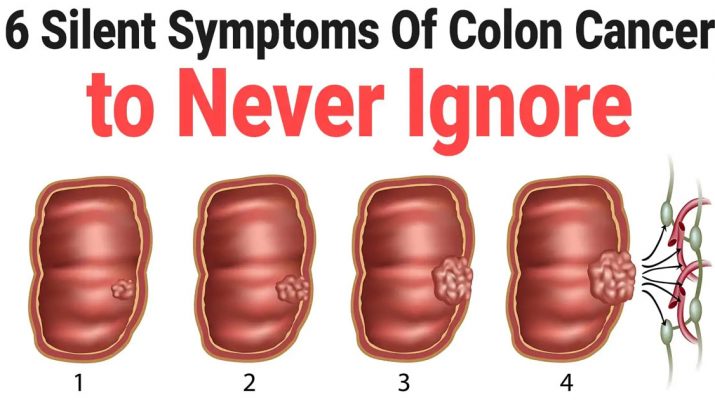 6-Silent-Symptoms-Of-Colon-Cancer-to-Never-Ignore