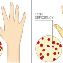 7 Signs of Chronic Iron Deficiency Most Women Ignore