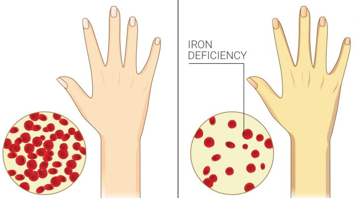 7-Signs-of-Chronic-Iron-Deficiency-Most-Women-Ignore