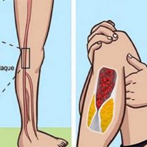 Here’s How to Thin Your Blood Naturally and Prevent Deadly Blood Clots