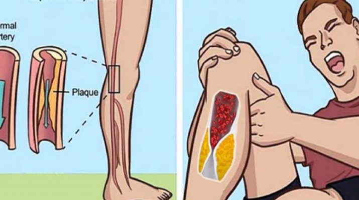 Here’s-How-to-Thin-Your-Blood-Naturally-and-Prevent-Deadly-Blood-Clots