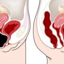 How To Remove Waste From Your Colon Quickly and Safely – Recipe