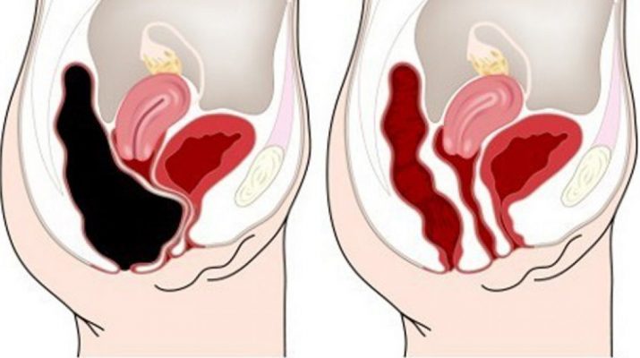 How-To-Remove-Waste-From-Your-Colon-Quickly-and-Safely-–-Recipe