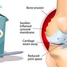 How to Use Baking Soda To Relieve Arthritis Pain