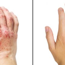 Researchers Reveal 15 Ways To Get Rid Of Eczema