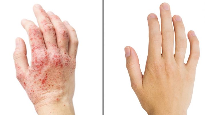 Researchers-Reveal-15-Ways-To-Get-Rid-Of-Eczema