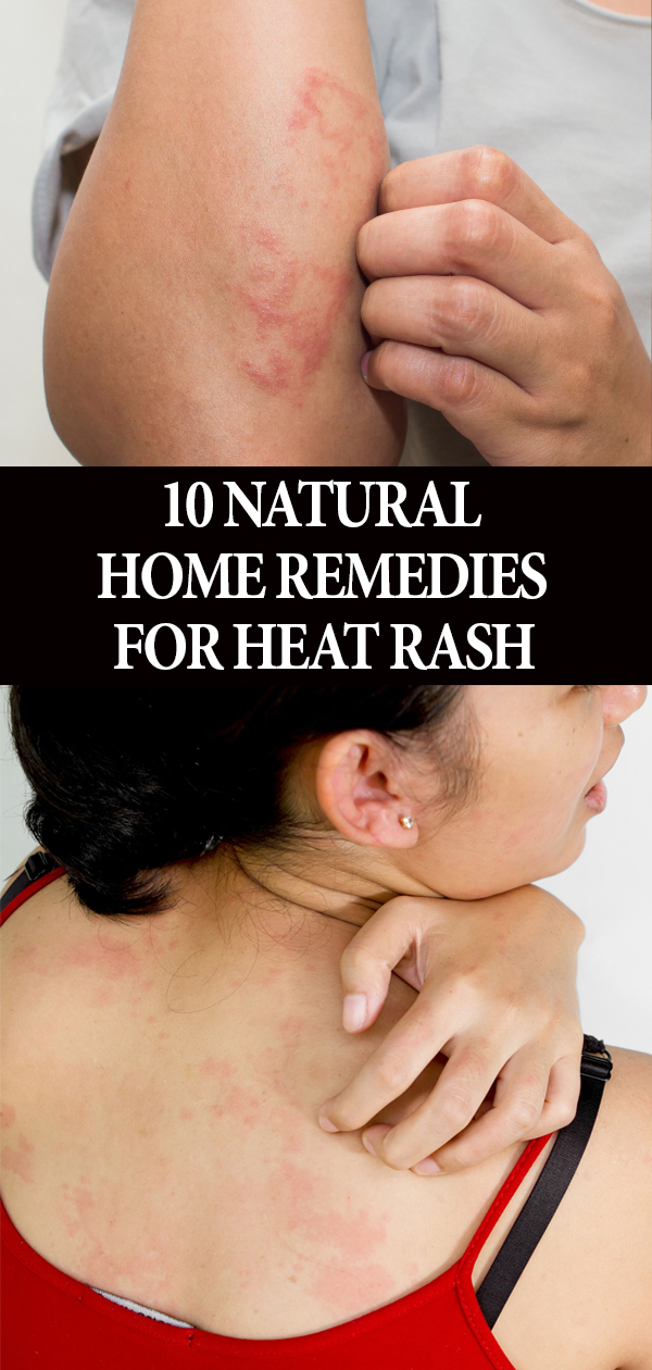 10-Natural-Home-Remedies-For-Heat-Rash-+-Prevention-Tips