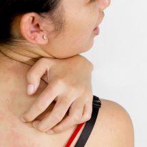 10 Natural Home Remedies For Heat Rash + Prevention Tips