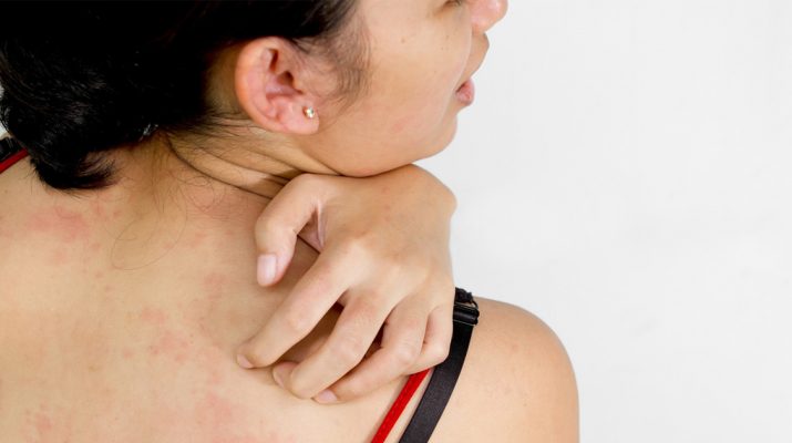 10-Natural-Home-Remedies-For-Heat-Rash-+-Prevention-Tips