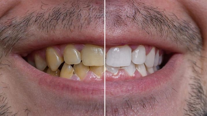 10-Ways-to-Clean-Yellow-Teeth-Naturally
