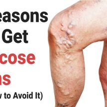 5 Reasons You Get Varicose Veins (And How to Avoid It)