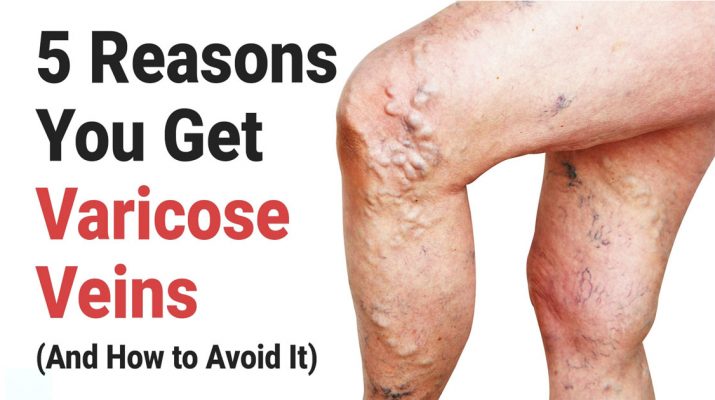 5-Reasons-You-Get-Varicose-Veins-(And-How-to-Avoid-It)