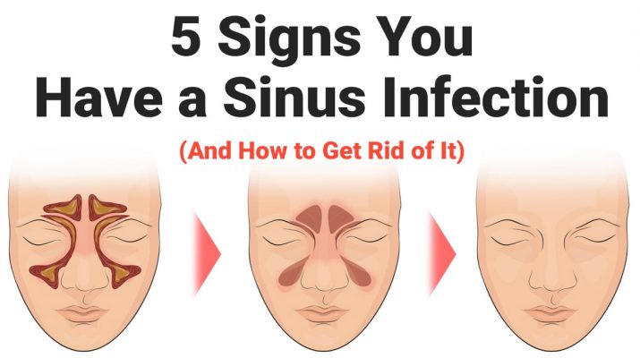5-Signs-You-Have-a-Sinus-Infection-(And-How-to-Get-Rid-of-It)