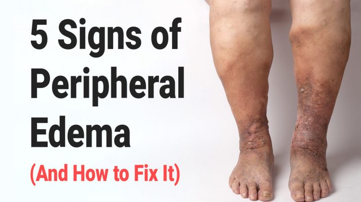 5-Signs-of-Peripheral-Edema-(And-How-to-Fix-It)