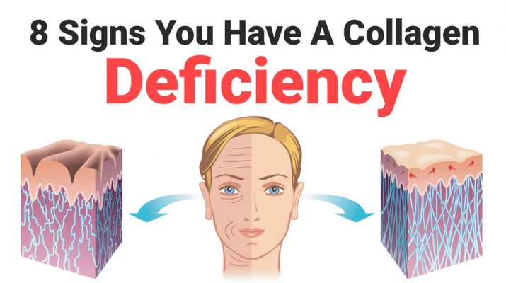 8-Signs-You-Have-A-Collagen-Deficiency