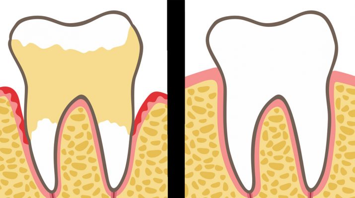 Dentists-Explain-7-Habits-That-Ruin-Your-Teeth-and-Gums-(And-How-to-Fix-It)