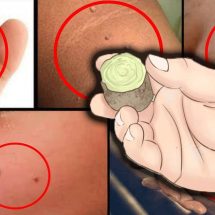 Destroy Your Moles, Warts, Blackheads, Age Spots And Skin Tags Completely Naturally