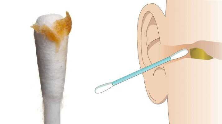 Ear-Specialists-Explain-6-Reasons-to-Stop-Cleaning-Ears-With-Cotton-Buds