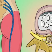 How to Release the Pinched Nerve in the Lumbar Area (sciatica)- 5 Simple Ways to Get Rid of the Pain