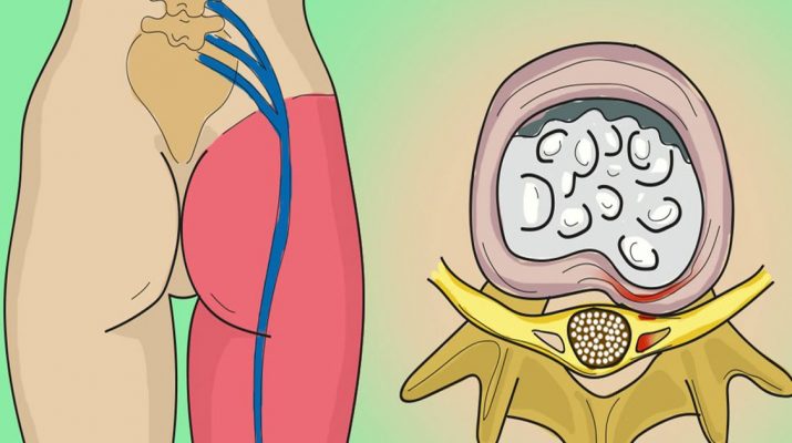 How-to-Release-the-Pinched-Nerve-in-the-Lumbar-Area-(sciatica)--5-Simple-Ways-to-Get-Rid-of-the-Pain