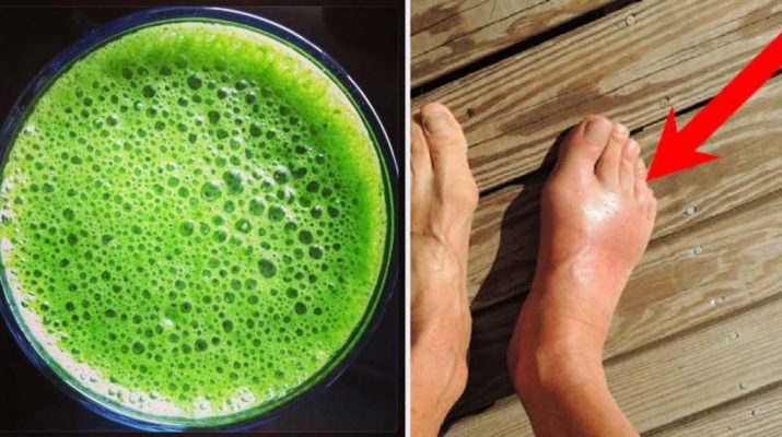How-to-Remove-Uric-Acid-Crystalization-in-Joints-for-Gout-and-Joint-Pain