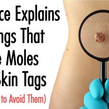 Science Explains 4 Things That Cause Moles And Skin Tags (And How to Avoid Them)