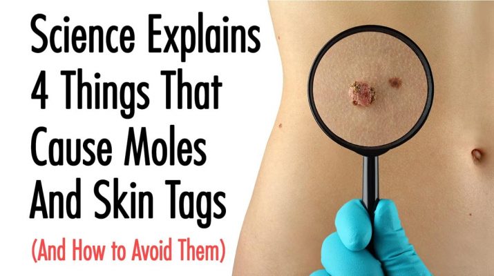 Science-Explains-4-Things-That-Cause-Moles-And-Skin-Tags-(And-How-to-Avoid-Them)