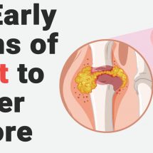 10 Early Signs of Gout to Never Ignore