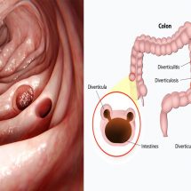 11 Foods That Make Diverticulitis Worse