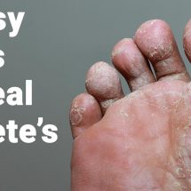 8 Easy Ways to Heal Athlete’s Foot